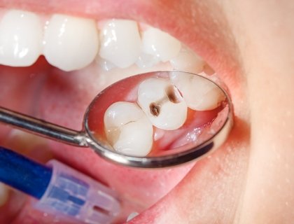 Ošetření zubního kazu