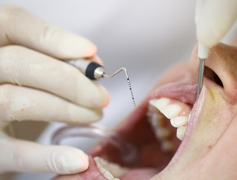 Endodoncie (Ošetření kořenových kanálků) Endodoncie (Ošetření kořenových kanálků)